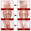 5 Pieces Exfoliating Foot Peel Mask Hydrating Moisturizing Smoothing for
