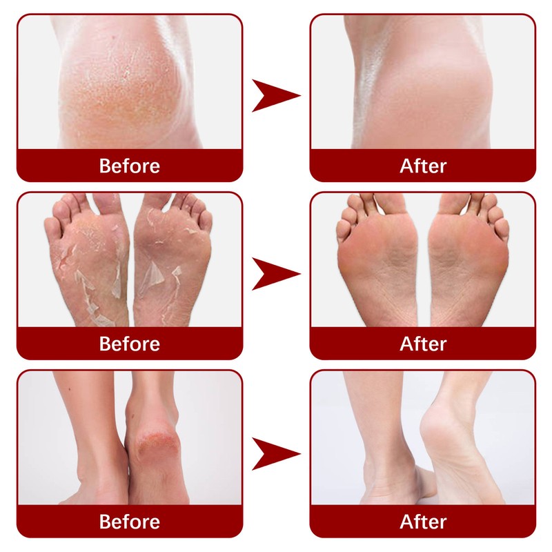 5 Pieces Exfoliating Foot Peel Mask Hydrating Moisturizing Smoothing for