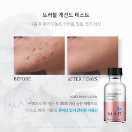 Mad Skin Care Acne Drying Lotion 30ml 1.Acne Drying Lotion 30ml x 1 / 매드스킨케어 아크네 드라잉 로션 30ml 1.아크네 드라잉 로션 30ml x 1개
