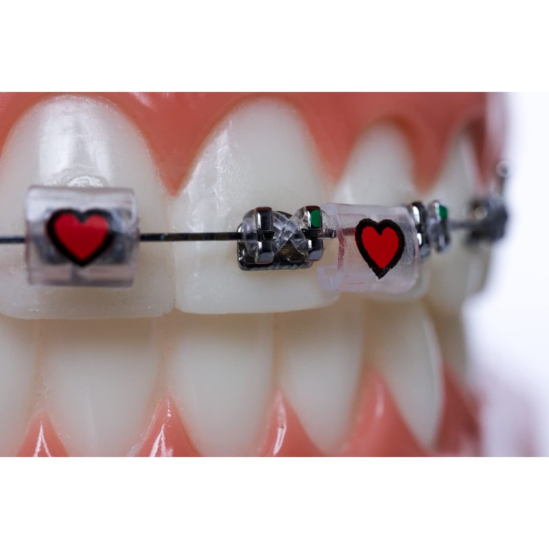 Snapcaps Braces Bumper Cover, Orthodontic Bracket Wax Substitute, Alternative Snap-on