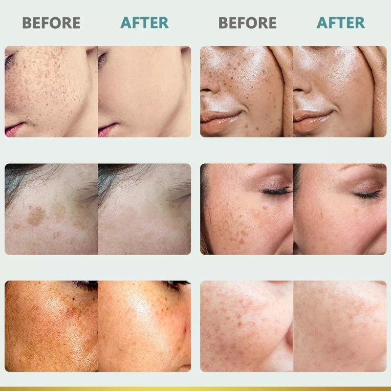 Citygoo Eliminador De Manchas Oscuras Para La Cara: Crema Co