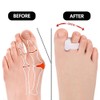 8 Stück Zehenspreizer, Hallux Valgus Korrektur, Hammerzehen Korrektur, Hallux Valgus