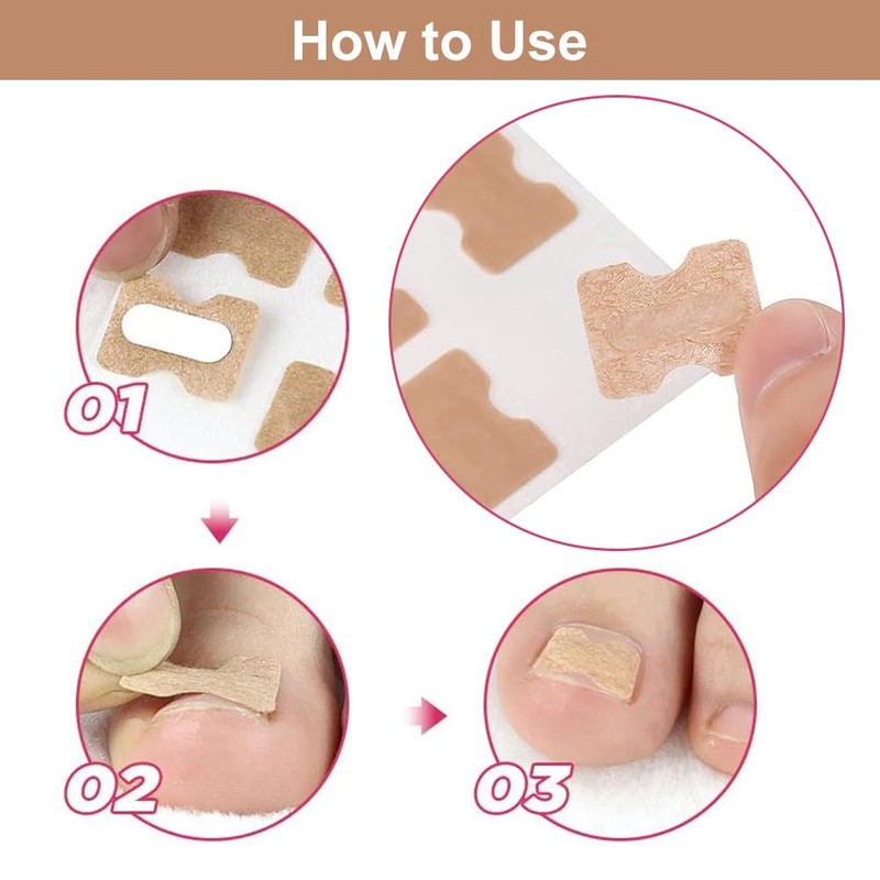 Ingrown Toenails Set, Toenail Correction, Toenail Patch, Toenail Correction Patch,