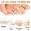 FOSDICK Pack of 20 Finger Splints, Breathable Buddy Loops Finger,