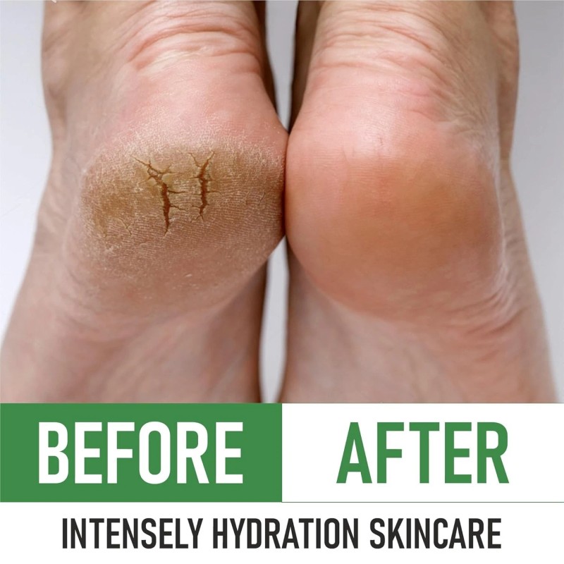 N/A Urea 40% Foot Cream With Pumice Stone & Brush