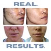 Clearogen Acne Treatment Kit, Acne Kit, Skin Care Acne, Acne