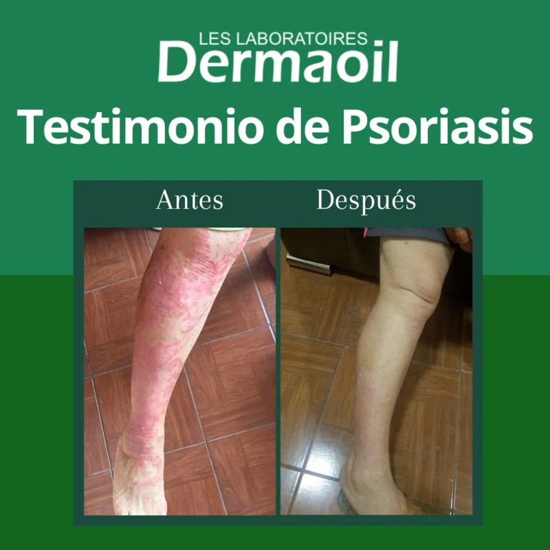Kit Especial Para Psoriasis: Pomada, Jabón Y Crema.