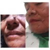 Jusse Anti Verrugas Lunares Mezquinos 15 Ml Sin Perfumar