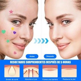 Parches Antiacné Absorbentes y Calmantes, Aplanan Imperfecciones