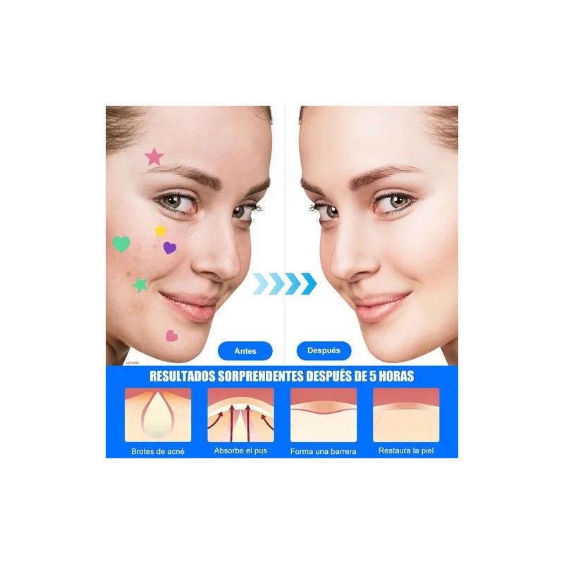 Parches Antiacné Absorbentes y Calmantes, Aplanan Imperfecciones