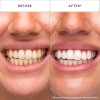 28 Parches De Limpieza De Dientes Morados Para Blanquear Los