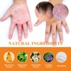 Wellness South Moon Anti-Itch Bee Venom Psoriasis Cream Cooling Soothing