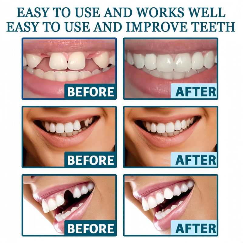Snap on Veneers Dentures Fake Teeth,Snap on Veneers Teeth,Temporary Ve/neers