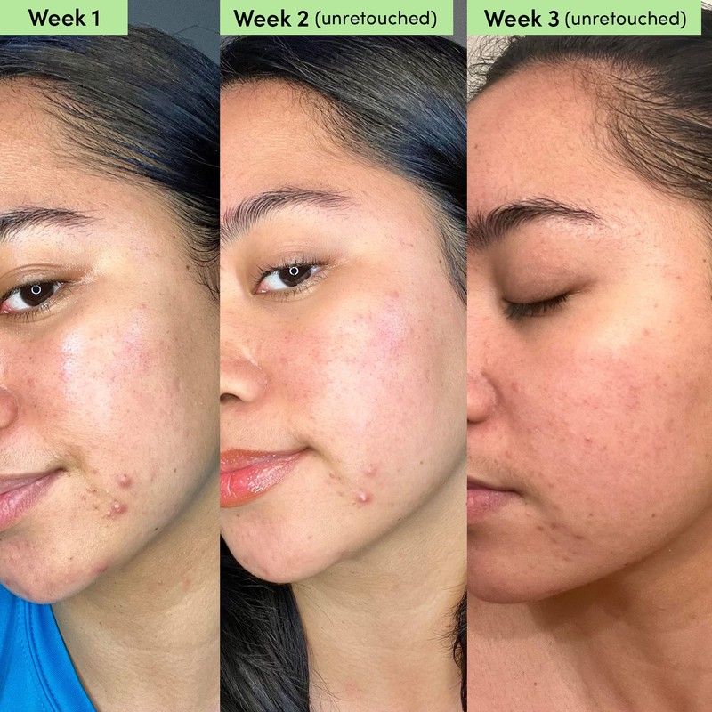 Sand & Sky Oil Control Blemish Clearing Clay Face Mask