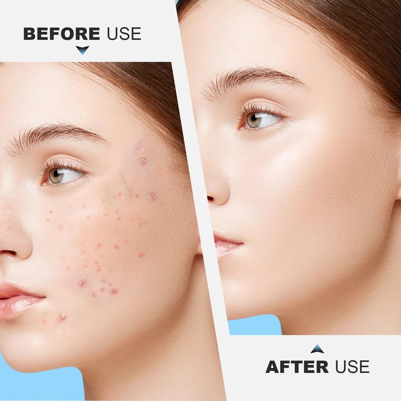 Vybiekr Stainless Steel Blackhead Remover, Pimple Extractor, Pimple Popper, Comedone