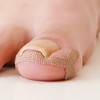 巻き爪ケアテープ 巻き爪テープ40枚入（1シート：4枚） 巻き爪シール ケア