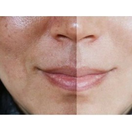 Crema Y Loción Elimina Manchas Paño Acne Sol Contaminación