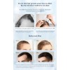 Shzhdikun Tamaño De Microagujas Ajustable 0-2 Mm Para Cabello Y
