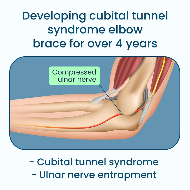 Microeagle Cubital Tunnel Syndrome Elbow Brace Splint For Ulnar Nerve
