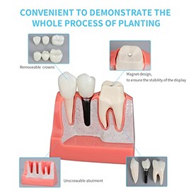 ANNWAN - Modelo de implante dental 4 veces extraíble análisis corona puente demostración modelo de dientes para educación de clase y estudio de dientes