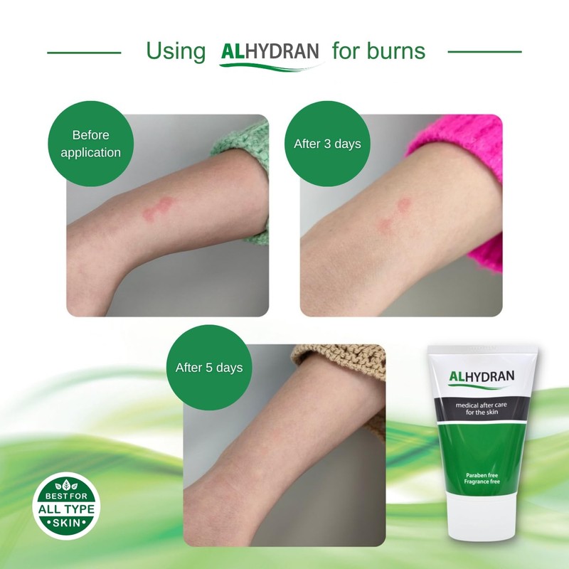 Alhydran After Care for The Skin | Scars, Dry Skin,
