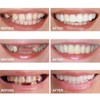 2 Pairs, Temporary Nature and Comfortable, Regain Confident Smile for