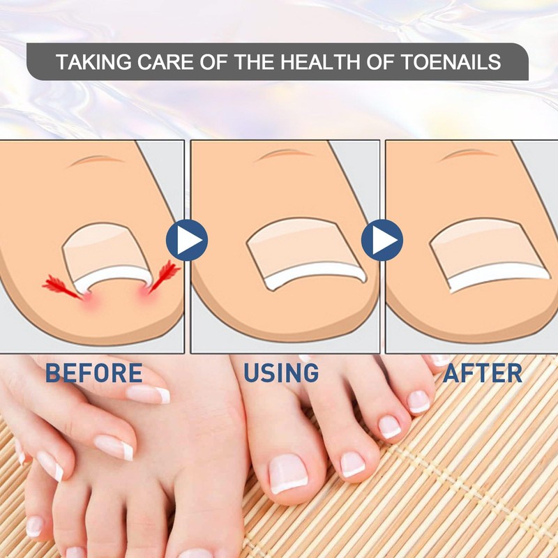 MFCGHXR Ingrown Toenails Tool Set 124 Pieces Toenail Correction Patch,