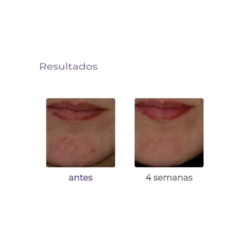 Sérum Derma&co. Derma Anti-acné -74% Acné Gb3 30 Ml. Acneica