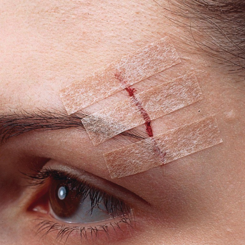 Nexcare Steri-Strip Skin Closures, Tan, 6 mm x 75 mm,