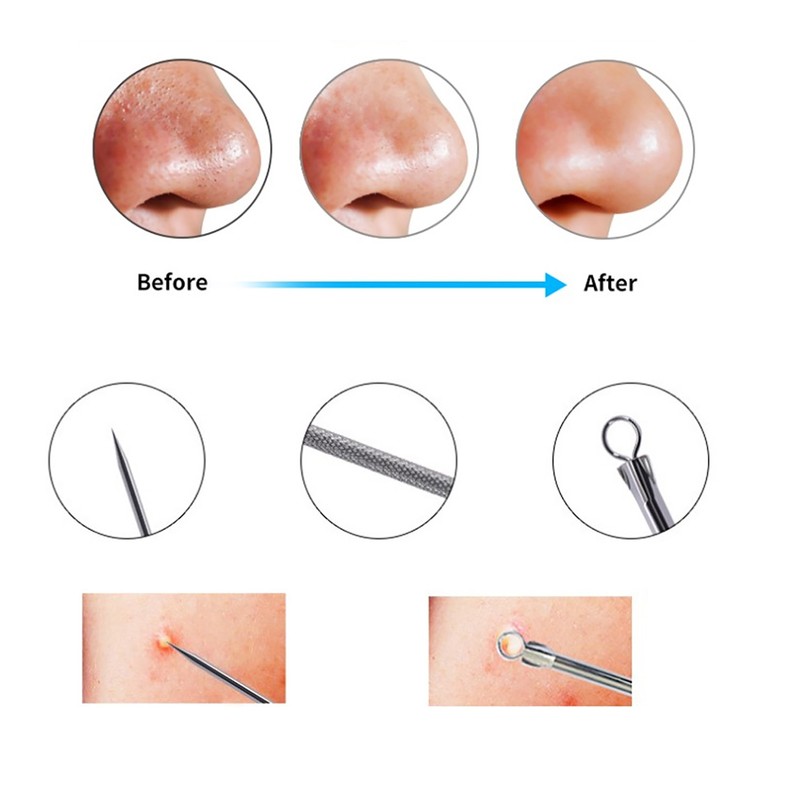 Blackhead Removal Rechargeable 5 Adjustable Suction Electric Pore Acne Cleaner