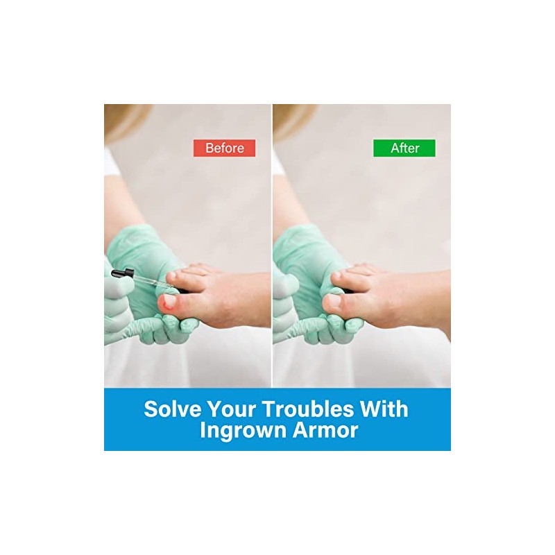 Ingrown Toenail Treatment Drops - Plant-Based Softener Solution