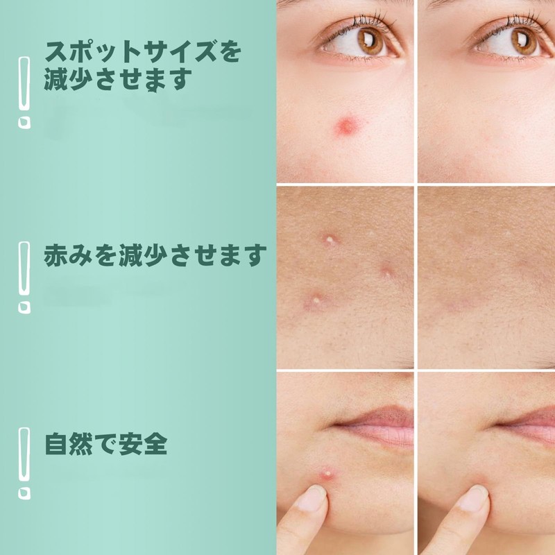 ACOTYE Comedone Patches, 210 Pieces, Acne Patches, Tea Tree Oil,