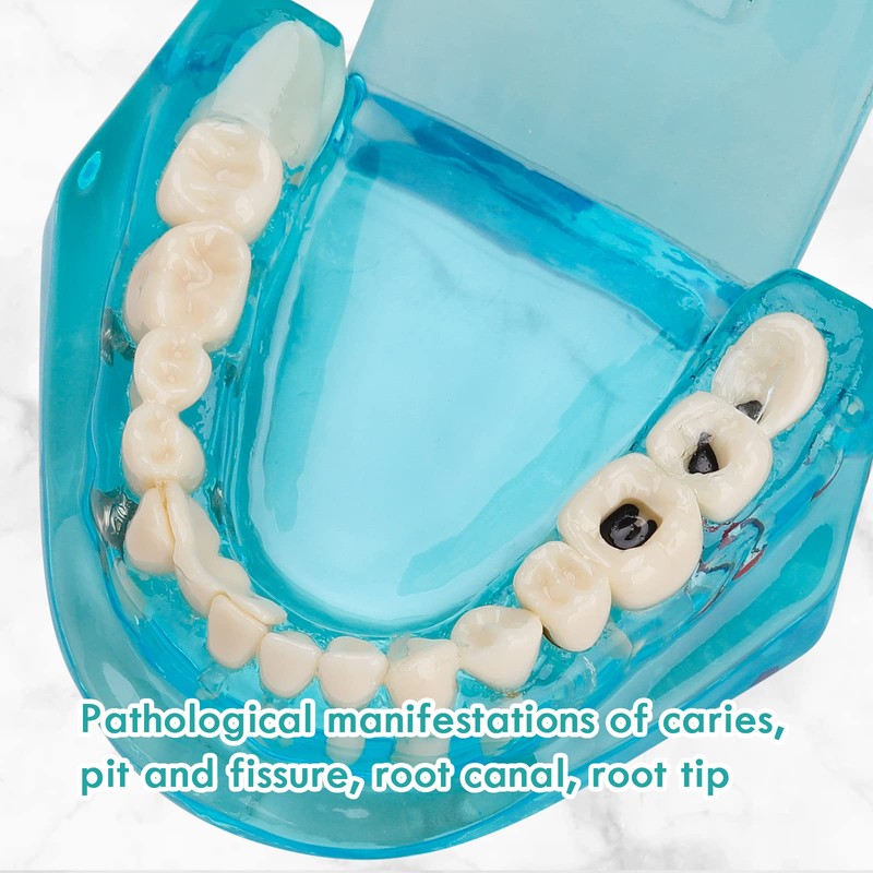 LVCHEN - Modelo de dientes de implante dental transparente, modelo