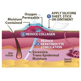 Scar Aid, tira de silicón grado médico, reduce cicatrices por cesárea.