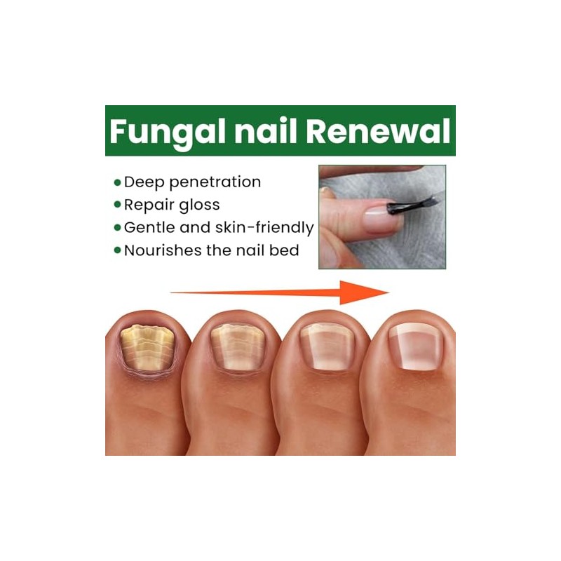 Ginger Nail, Tratamiento de Uñas con Jengibre, Soporte para Uñas,