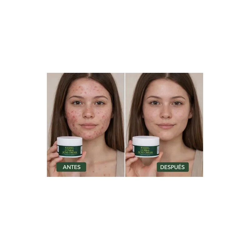 Crema Herbal Piel Con Imperfecciones Control Grasa Facial