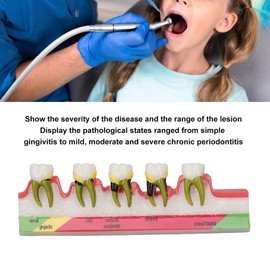 Teeth Periodontitis Model, Dental Periodontitis Display Model, Teeth Periodontitis Model Various Stages Resin Dental Periodontitis Display Model for Study, Teaching