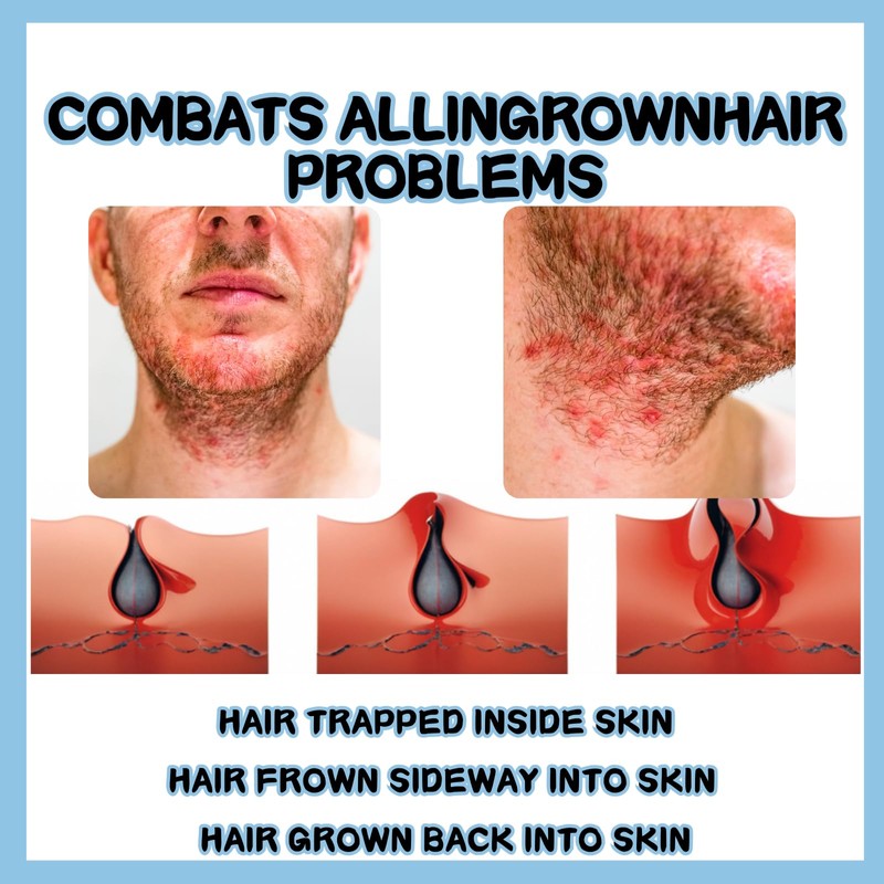 SHEBEEDO SHEBEEDO Razor Bumps Treatment For Men And Women Ingrown