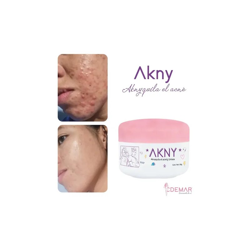 Akny Crema Para Eliminar Acné