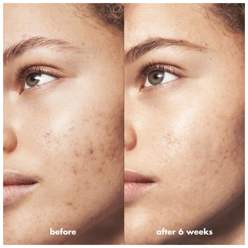 Blemish Breakthrough Acne Fighting Spot Gel