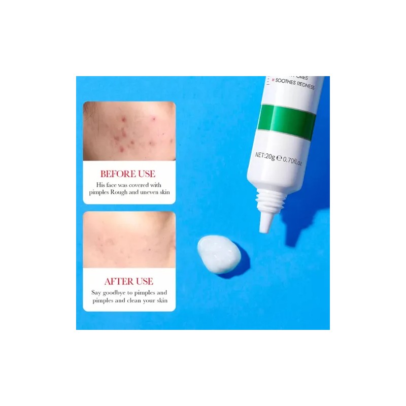Crema Ácido Salicílico Control Acné Piel Grasa 20g