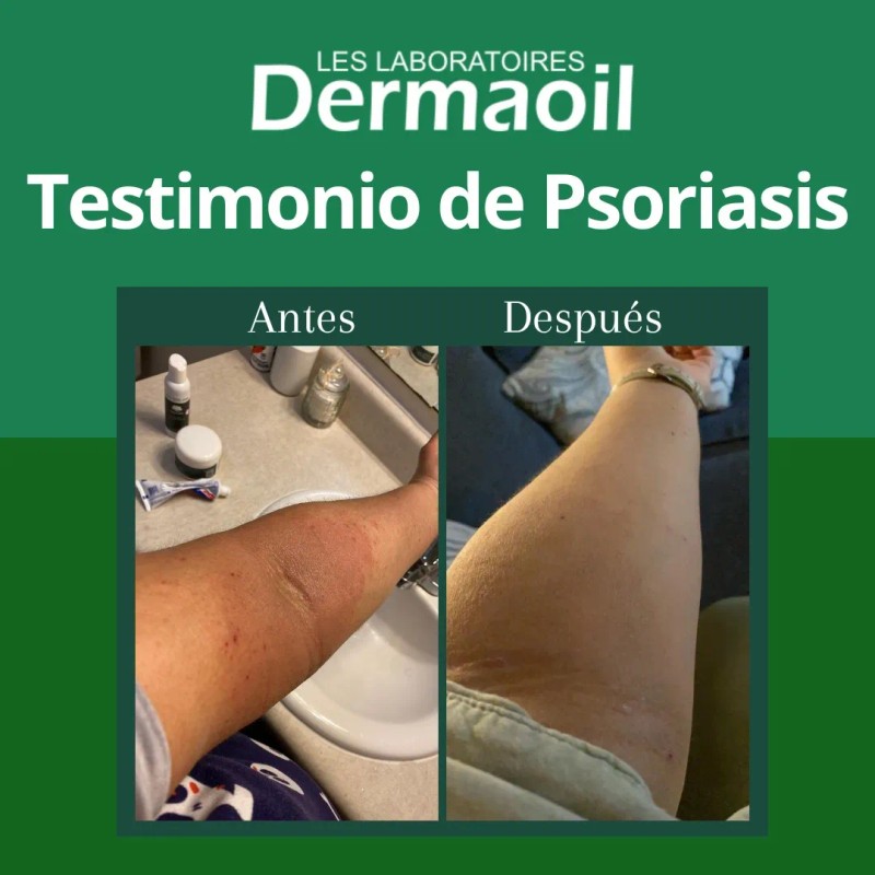 Pomada Natural Para Psoriasis: Hidratación Profunda.