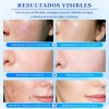 Acne Buster Loción Secante Con Ácido Salicílico 10ml