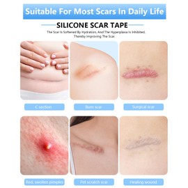 Silicone Scar Shees,Silicone Scar Tape,Treatment Roll, 1.6 x 60 inches, Medical Grade Adhesive Patches for Surgical, C-Section, Burn Scars (1.5M)