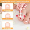 Joycabin Ingrown Toenails Set, Toenail Correction Patch, Ingrown Toenail Correction