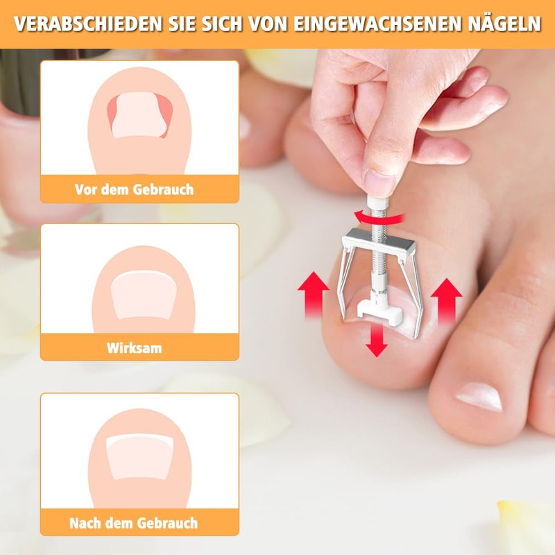 Joycabin Ingrown Toenails Set, Toenail Correction Patch, Ingrown Toenail Correction