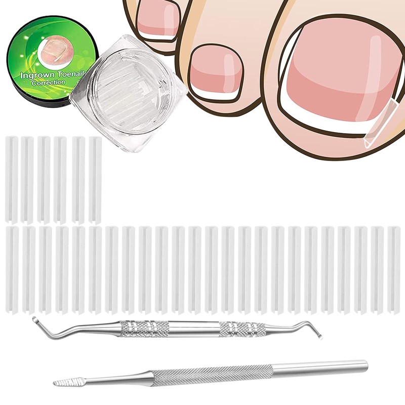 (30+2) Pack Ingrown Toenail Correction Treatment Kit, 30PCS Ingrown Toenails