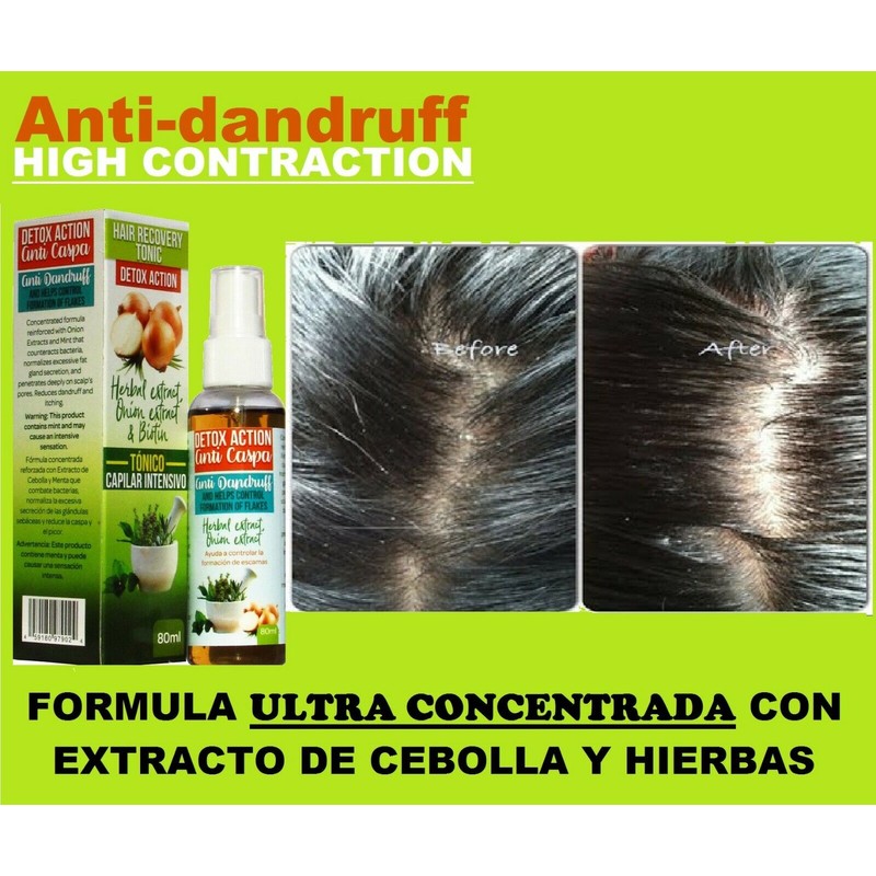 AntiDandruff ANTI CASPA ULTRA Concentrado Treat Psoriasis Flakes Scales 2