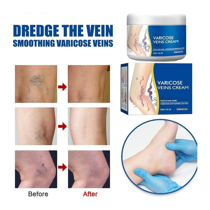 Lmuwecno Varicose Veins Cream(1PCS)