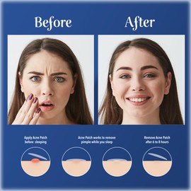 1 Pack - Dr Smooth Skin Acne Patch, 36 Hydrocolloid Patches, Blemish Remover, Acne Remover, 2 Size Patches 8mm, 12mm (1 Pack)